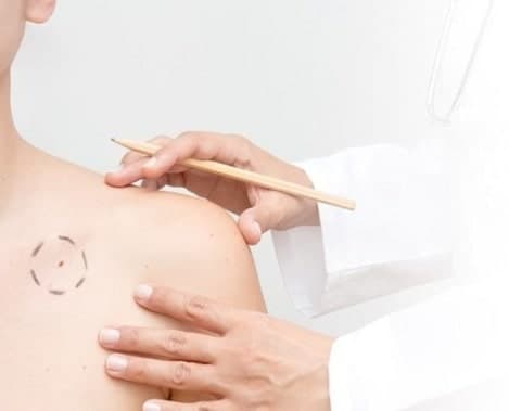 Удаление папиллом