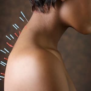 Акупунктура